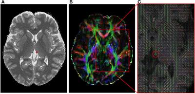 Thalamo-Habenular Connection Differences Between Patients With Major Depressive Disorder and Normal Controls